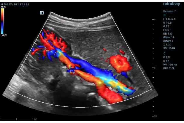 Doppler Ultrasound for DVT: Detection & Accuracy