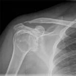Shoulder X-Ray procedure at DCDC Dubai Healthcare City